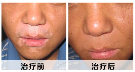 白癜风康复前后肤色会不会不一样