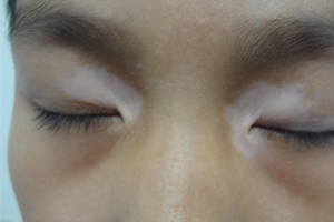 面部白癜风该如何预防