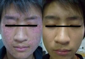 小面积面部白癜风治疗费用贵吗