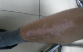 腿部出现白癜风该怎么治疗呢