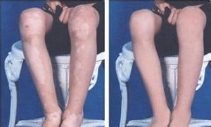 散发型白癜风患者可以吃西瓜吗