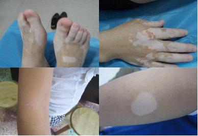 脚部白癜风危害有什么