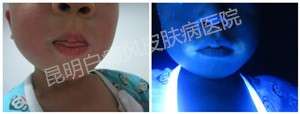 4岁男孩双嘴角白斑