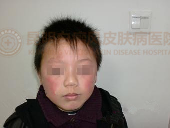 8岁男孩右侧眉上侧白斑1年