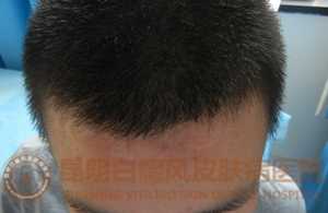 19岁男生额头白斑3年