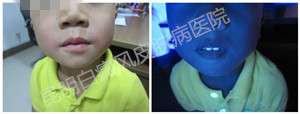 4岁男孩双嘴角白斑
