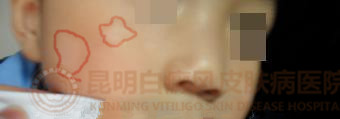 5岁男童面部白斑1年
