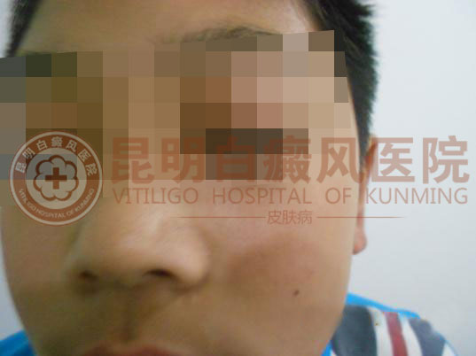 花季少年患白癜风一年