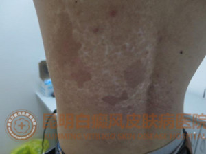 17岁男生背部大面积白斑