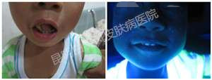 4岁男孩双嘴角白斑