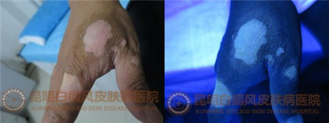 38岁男子手部白斑1年