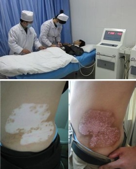 白癜风要分型分期治疗的原因