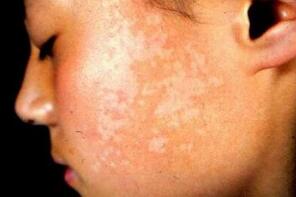 脸部白癜风有什么表现