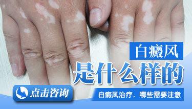 白癜风患者一般都会有哪些症状