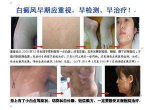 进展期白癜风的症状表现