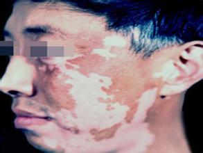 面部白癜风的常见症状表现