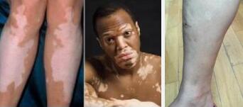 完全型白癜风的主要症状表现