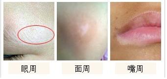 脸上患上白癜风一般有什么症状表现
