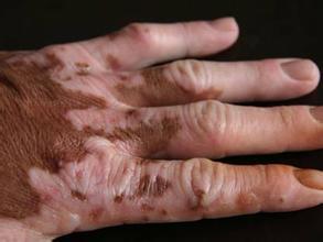 白癜风患者错误使用偏方的危害是什么