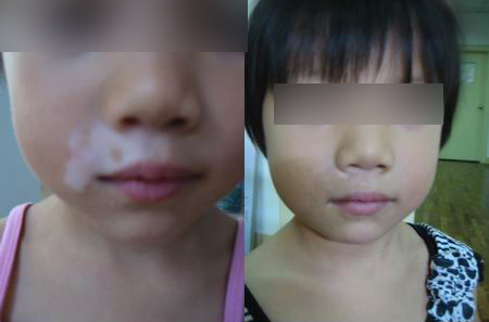 孩子身上出现白癜风后该如何治疗