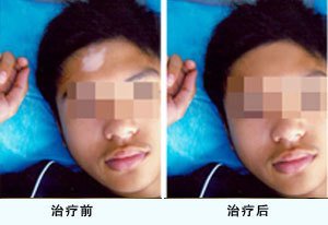 青少年白癜风部位该怎样保养