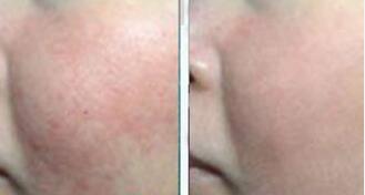 如何有效治疗脸部白癜风呢