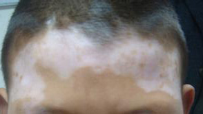 脸上的白癜风需要多久才能治好呢