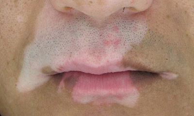 患者面部的白癜风该如何有效治疗呢