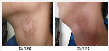 颈部白癜风使用移植方法治疗后还需吃药吗