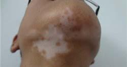 脖子上的白癜风需要如何护理