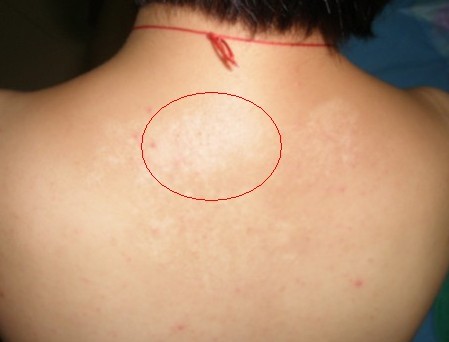 患者脖子上的白斑是白癜风吗