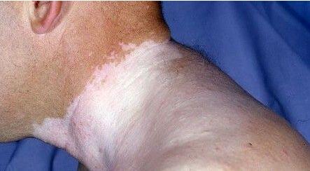 颈部与肩膀之间的白斑该如何诊断