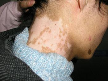 患者该如何治疗颈部白癜风呢