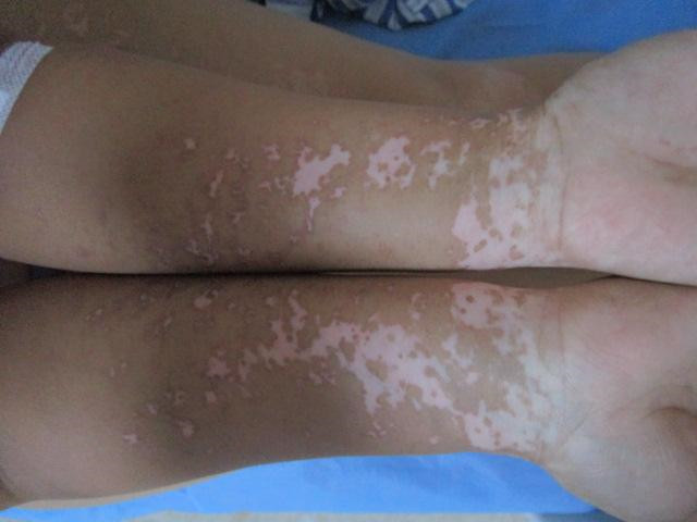 肢端型白癜风病情该如何有效治疗