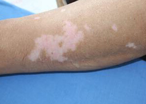 治疗手臂白癜风什么方法比较好