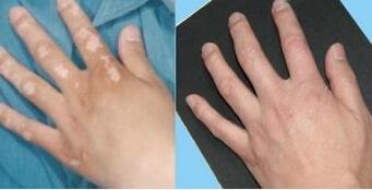 患者手上的白癜风用什么方法治疗好