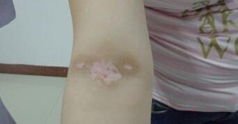 手部白癜风疾病会扩散到脸上吗