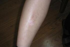 腿部出现白癜风会有哪些症状表现