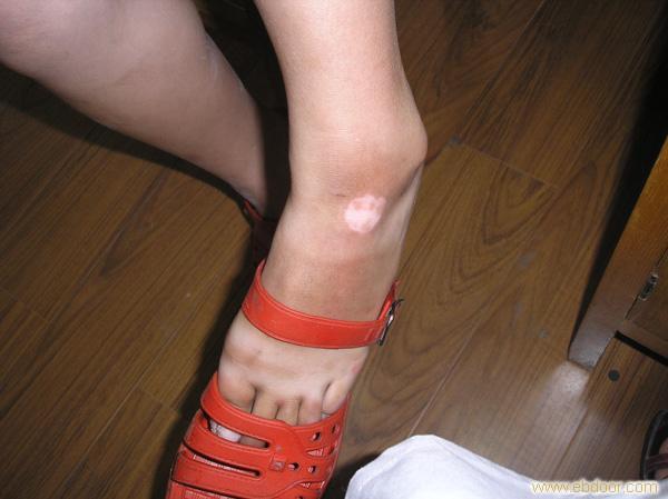 脚部白癜风如何才能成功康复