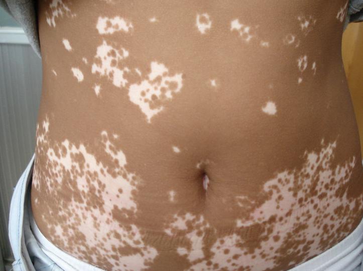 腰部的白点成片具体该怎么对待