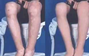 肢端型白癜风应该怎么护理