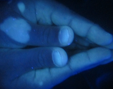 患者怎样使用伍德灯诊断身上的白斑症状