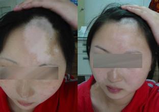 治疗头部白癜风方法是什么