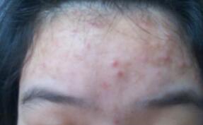 头部出现白癜风会有什么表现