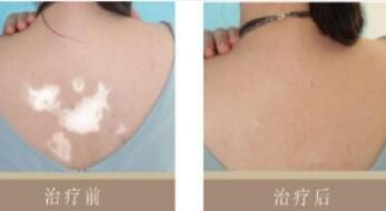 后背有白癜风能治好吗