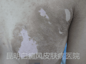 14岁女生胸部患白癜风4个月余,在我院康复