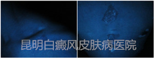 20岁男性身上多块白斑,在我院成功康复