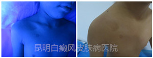 八岁女童锁骨处患白斑,在我院成功康复