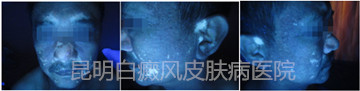 面部白斑五年余,在我成功治疗