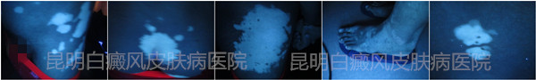 22岁男性身患白癜风6年余,在我院成功治疗